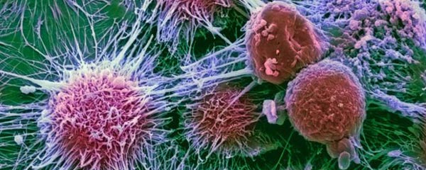 Cancer : Priorité au diagnostic précoce