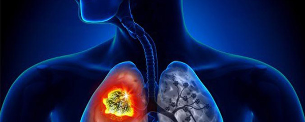 Lutte contre la tuberculose : Objectif non-atteint