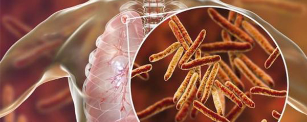 Tuberculose : Un nouveau médicament contre ses formes les plus mortelles
